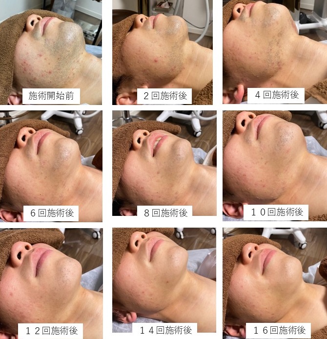 推移１